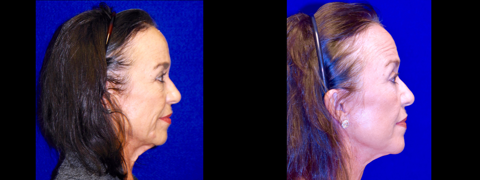 Right Profile View - Lower Facelift