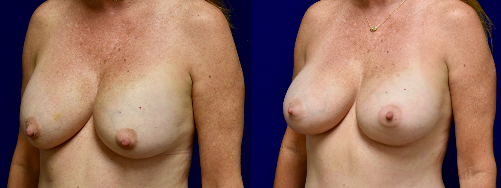 Left 3/4 View - Breast Implant Revision