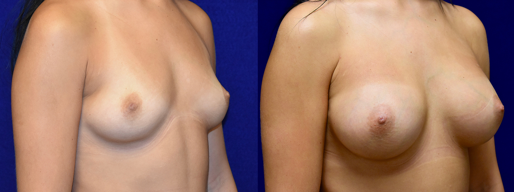 Right 3/4 View - Breast Augmentation