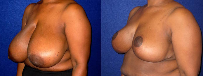 Breast Reduction Before and After Photos