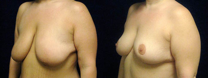 Breast Lift After Gastric Bypass