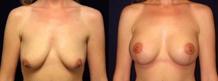 Breast Augmentation with Lift After Weight Loss