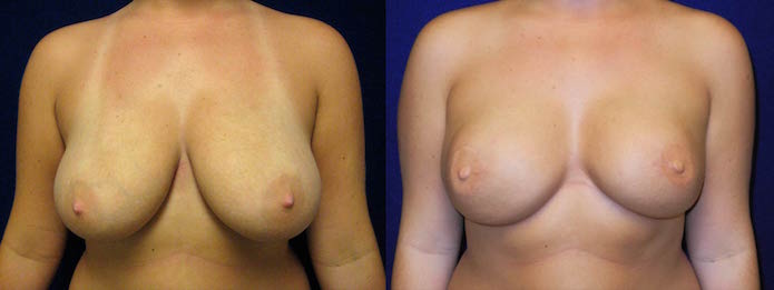Latissimus Flaps Breast Reconstruction with Silicone Implants