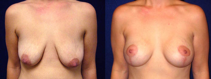 Breast Augmentation with Lift After Breastfeeding