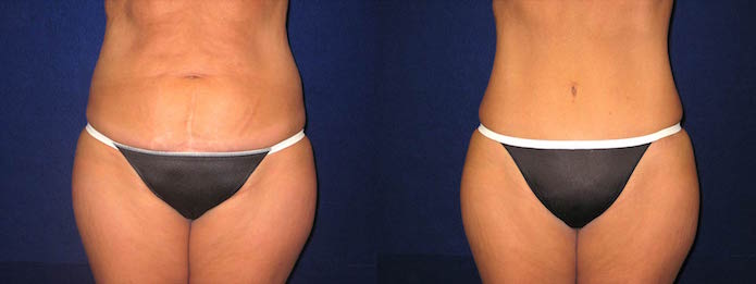 Tummy Tuck with no Pre-surgery Weight Loss