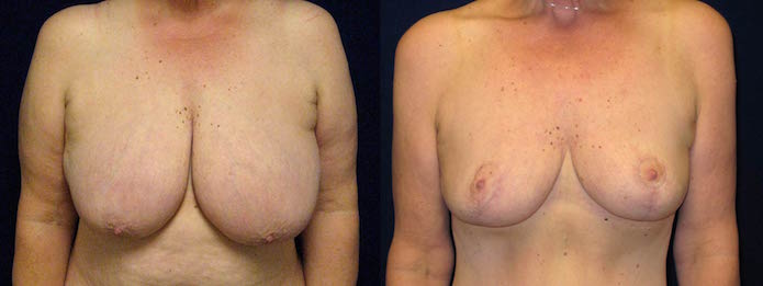 Breast Reduction with Breast Lift After Weight Loss