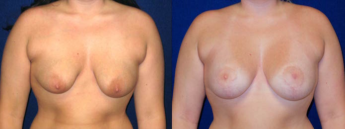 Breast Asymmetry Correction by Augmentation with Lift