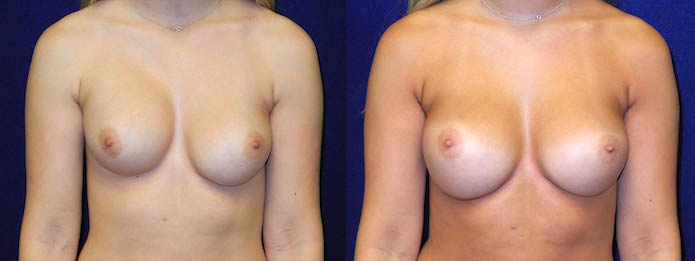 Breast Implant Revision Surgery