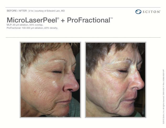 Profactional Laser Treatment