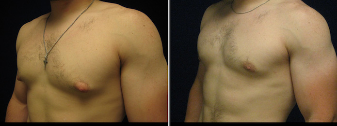 Adult Male Breast Reduction