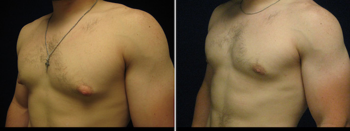 Adult Male Breast Reduction