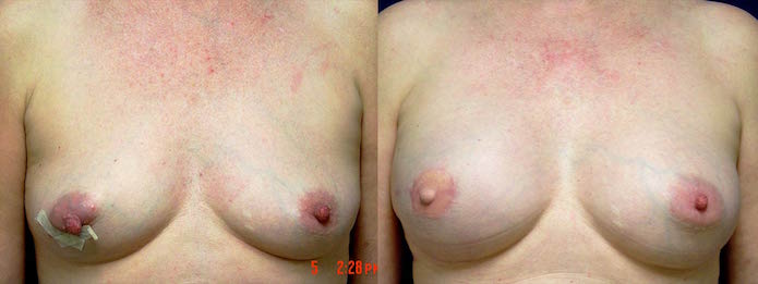 Breast Reconstruction Latissimus Flap