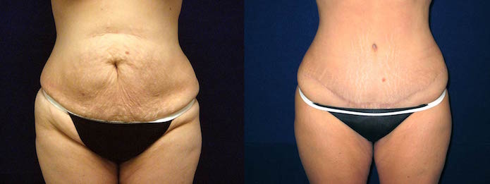 Tummy Tuck After Liposuction
