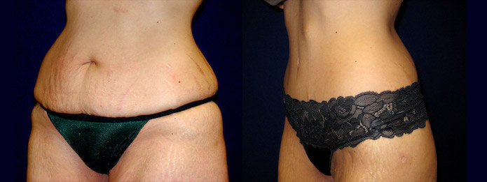 Cirumferential Tummy Tuck - Left 3/4 View