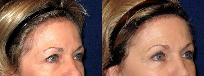 Upper Eyelid Surgery