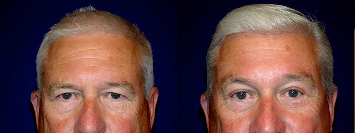 Male Upper Eyelid Surgery, Browlift, and Facelift