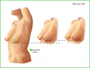 breast lift