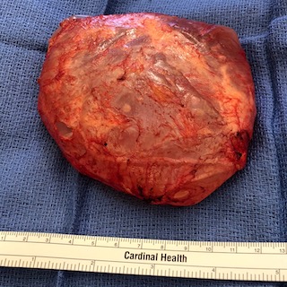Total capsulectomy with the implant still inside the capsule or scar.