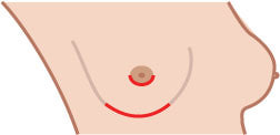 Nipple Sparing Mastectomy