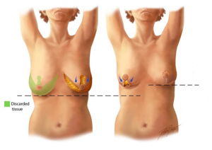 Breast Reduction: 4/5 months update 36DDD TO 34C 😱😱 