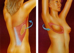 Skin sparing latissimus breast reconstruction