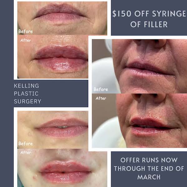 $150 Off Fillers!