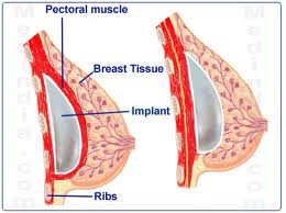 Breast augmentation post-op