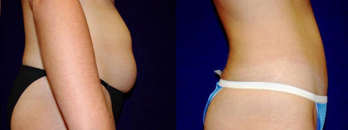 Liposuction After Pregnancy