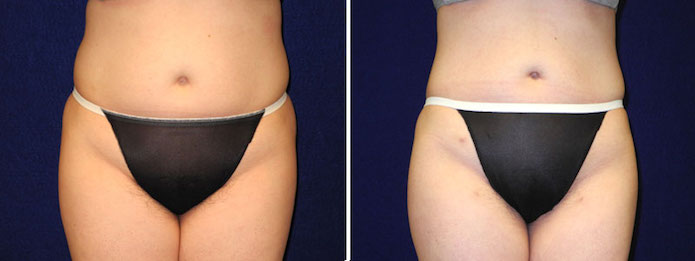Liposuction - Abdomen, Flanks, and Inner Thighs