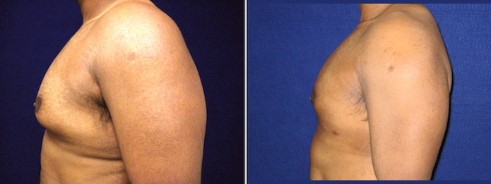 Male Breast Reduction via Liposuction