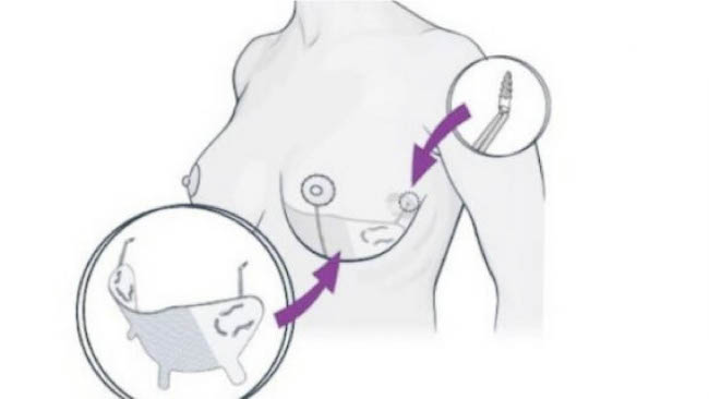 Galaflex Implant Position Support