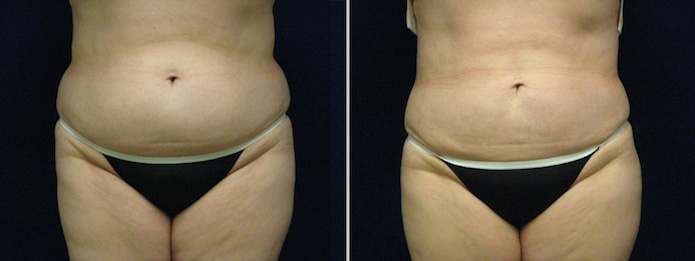 Tumescent Liposuction