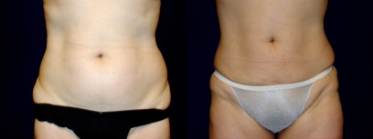Frontal View - Liposuction