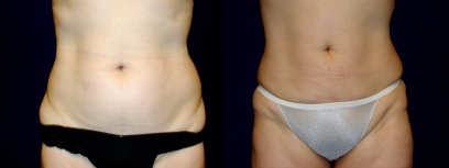 Frontal View - Liposuction Frontal View - Liposuction