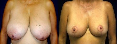 Frontal View - Breast Reduction