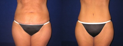 Frontal View - Tummy Tuck After Pregnancy