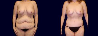 Frontal View - Surgery After Weight Loss - Breast Lift & Tummy Tuck Frontal View - Surgery After Weight Loss - Breast Lift & Tummy Tuck
