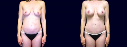 Frontal View - Breast Augmentation & Abdominoplasty