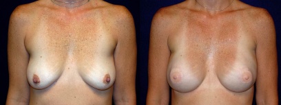Frontal View - Breast Reconstruction Frontal View - Breast Reconstruction
