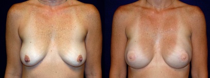 Frontal View - Breast Reconstruction