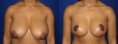 Frontal View - Breast Reduction Frontal View - Breast Reduction