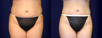 Frontal View - Liposuction