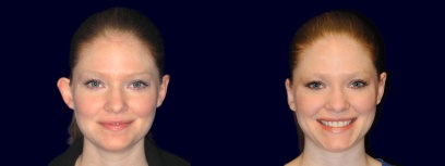 Full Fontal View - Otoplasty Full Fontal View - Otoplasty