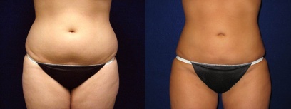 Frontal View - Liposuction Frontal View - Liposuction