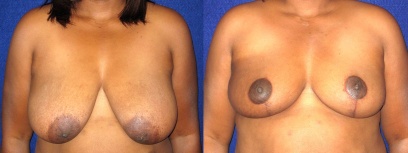 Frontal View - Breast Reconstruction