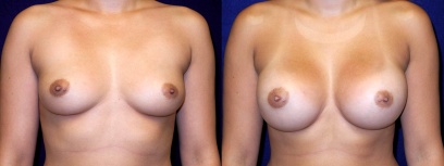 Frontal View - Breast Augmentation - Silicone Implants Frontal View - Breast Augmentation - Silicone Implants