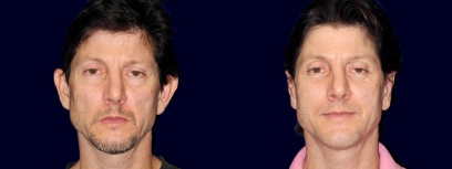 Fontal View - Otoplasty with Chin Augmentation Fontal View - Otoplasty with Chin Augmentation