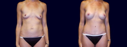 Frontal View - Breast Augmentation and Tummy Tuck Frontal View - Breast Augmentation and Tummy Tuck