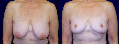 Frontal View - Breast Lift