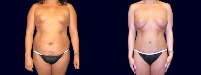 Frontal View - Breast Augmentation with Periareolar Lift & Tummy Tuck Frontal View - Breast Augmentation with Periareolar Lift & Tummy Tuck